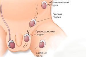 Не опустилось яичко у годовалого ребенка