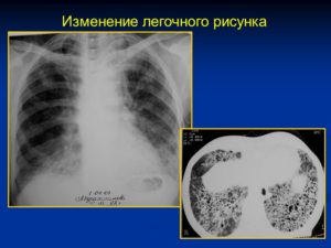 Фиброзная деформация легочного рисунка