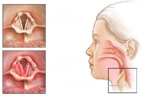 Гиперплазия гортани