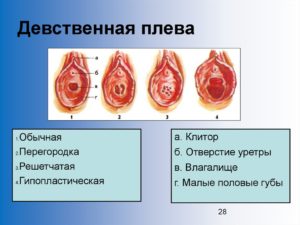 Неполная дефлорация