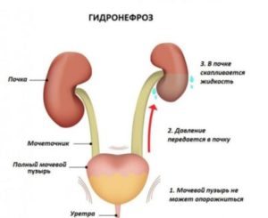 Гидронефроз при беременности