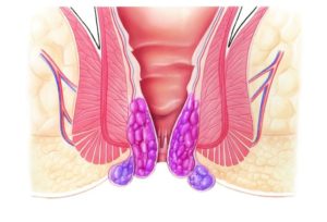 Опухоль в заднем проходе