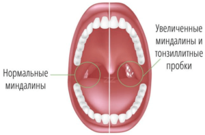 Одна миндалина больше другой