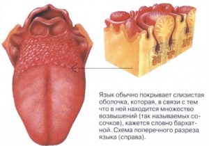 Гипертрофированное сосочки языка