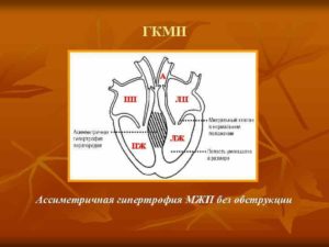 Гипертрофия межжелудочковой перегородки