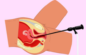 Гистероскопия при эндометриозе