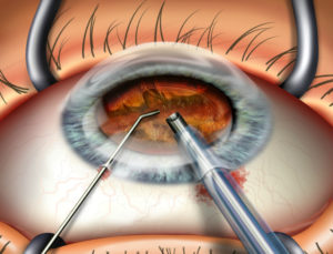 Операция после факоэмульсификации глаза
