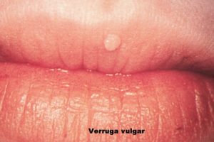 Папиллома на половой губе и коричневое пятно на слизистой