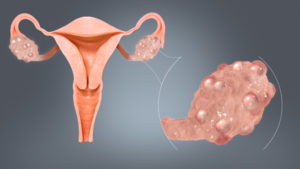 Оральные контрацептивы, мультифолликулярные яичники и акне