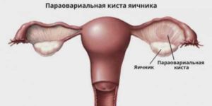 Параовариальная киста+эндометриоз