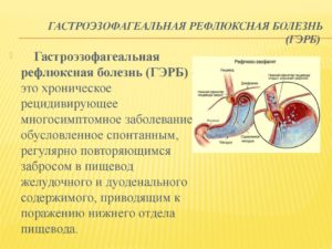 Гастроэзофагеальная рефлюксная болезнь