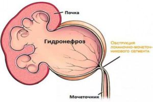 Гидронефроз при беременности