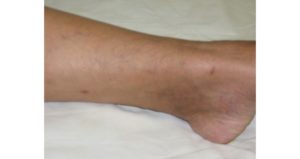 Гнойное высыпание после операции по удалению вен на ноге