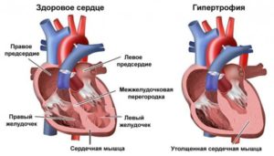 Гипертрофия Сердца