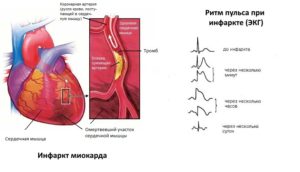 Низкий пульс и давление после инфаркта