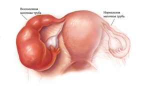 Гидросальпинкс беременность