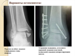 Не заживает рана после операции, остеосинтез пяточной пластины