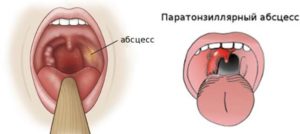 Опухла левая миндалина