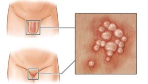 Герпес на лобке
