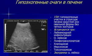 Объемное образование левой доли печени