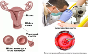 Осложнения биопсии шейки матки