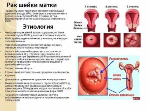 Гиповаскулярное образование на культе шейки матки