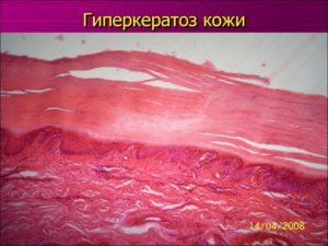 Гиперкератоз плоского эпителия вульвы