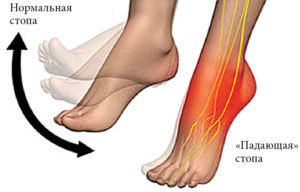 Онемела голень, неврит малоберцового нерва