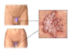Папилломы на клиторе