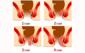 Геморрой не проходит более полугода