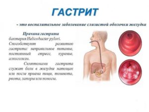 Неприятный привкус при гастрите и реакция на лекарства