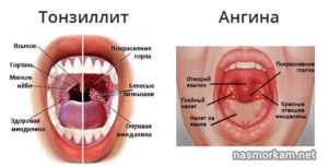 Опух нёбный язычок во время ангины