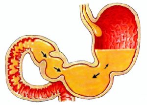 Недостаточность кардии. Эритиматозная гастропатия, дуодено-гастральный рефлекс