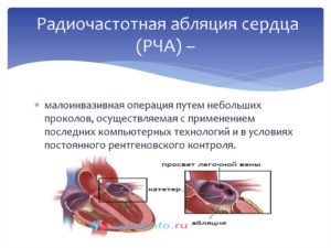 Одышка после рча (абляции) сердца