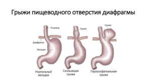 Грыжа пищеводного отверстия диафрагмы