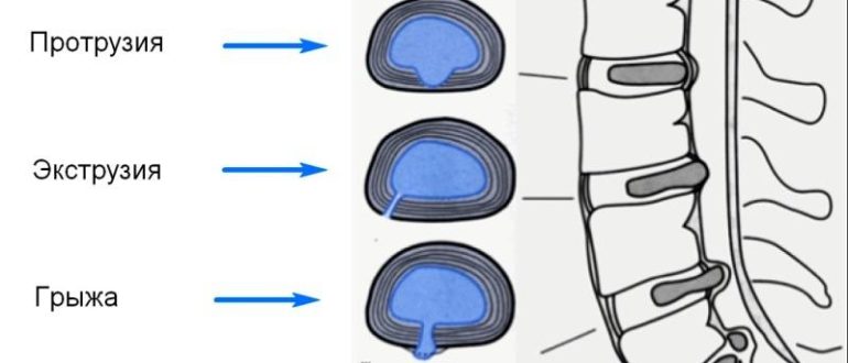 Сублигаментарная экструзия. Задняя срединно бипарамедианная ,фораментальная грыжа диска 5,5 см.