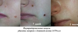 Фото после удаления родинки