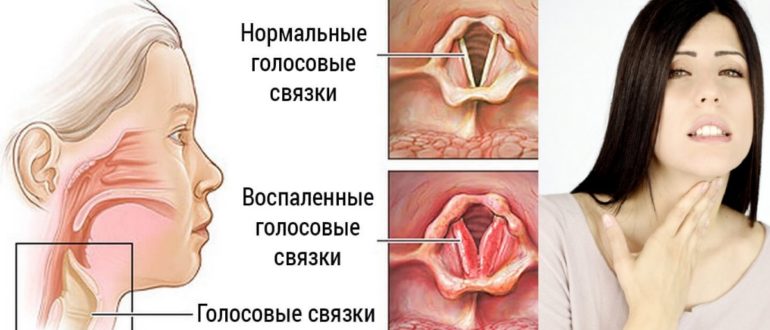 Очень чешется горло и хочется кашлять