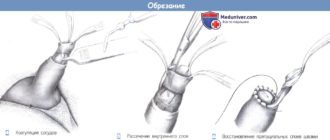 Обрезание Отек или нет? И что делать чтобы прошло