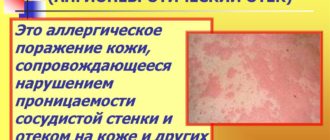 Острая крапивница, отек