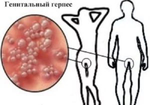 Герпес 2 типа как жить дальше