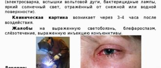 Ожог глаз УФ