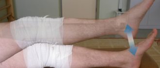 Онемение ниже колена после эндопротезирования тазобедренного сустава