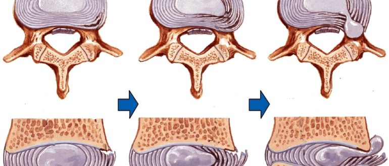 Грыжи и протрузии дисков позвоночника