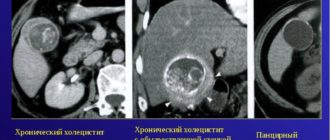 Незначительное увеличение печени, хронический холецистит