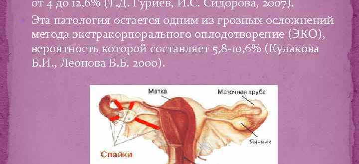 Не проходящие боли после тубэктомии