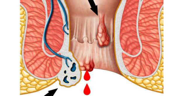 Геморройные узлы и кровь