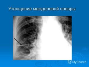 Фиброзные изменения в легочной ткани, уплотнение междолевой плевры справа