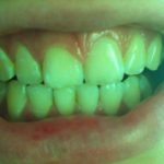 Горечь во рту после лечения зуба