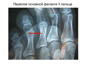 Перелом 3 пальца на ноге и осколок 4 пальца левой ноги